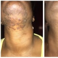 What to Know Before and After Laser Hair Removal